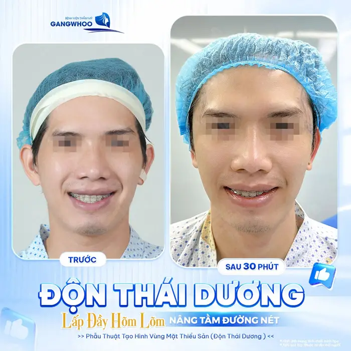 Độn thái đương lấp đầy hõm lõm nâng tầm đường nét thêm hài hòa và cân đối đầy thăng hạng