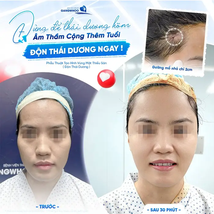 Căn chỉnh thái dương lõm hóp độn thái dương kết quả sau 30 phút diện mạo thêm hài hòa và cuốn hút
