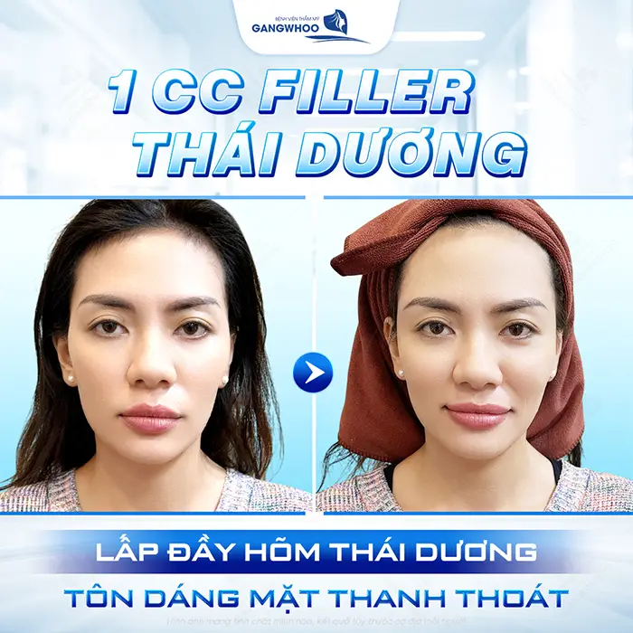 Độn Thái Dương Rồi Có Tiêm Filler Được Không? Giải Đáp Từ Bác Sĩ Chuyên Khoa