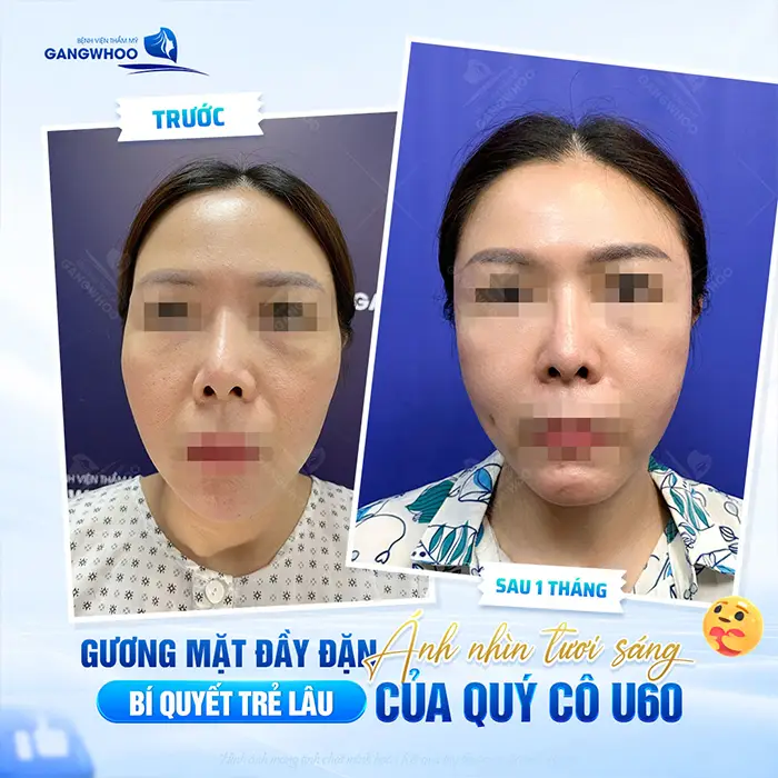 Độn Thái Dương Rồi Có Tiêm Filler Được Không? Giải Đáp Từ Bác Sĩ Chuyên Khoa