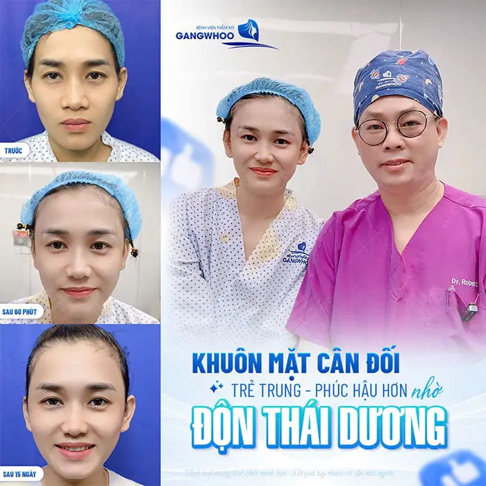 Độn Thái Dương Rồi Có Tiêm Filler Được Không? Giải Đáp Từ Bác Sĩ Chuyên Khoa
