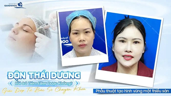 don thai duong roi co tiem filler duoc khong