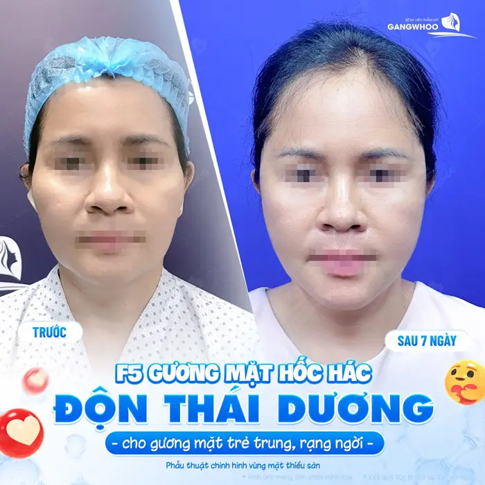 Tạm biệt gương mặt hốc hác sau 7 ngày độn thái dương diện mạo đã trẻ trung và rạng rỡ hơn hẳn