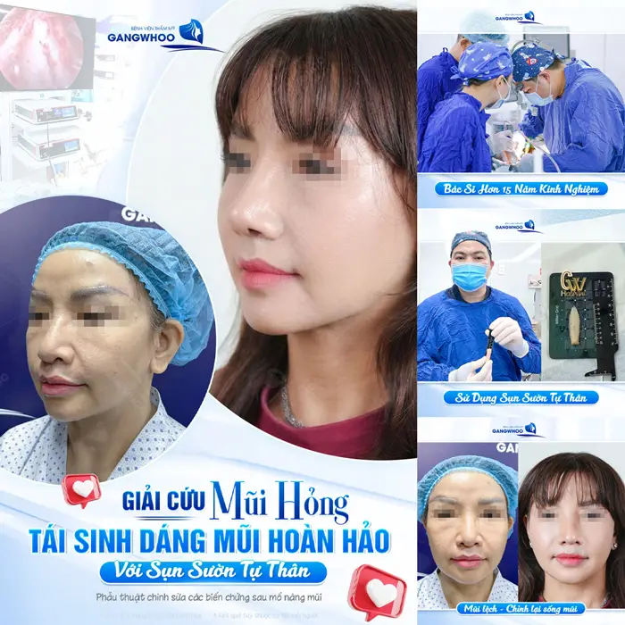 Giải cứu mũi hỏng tái sinh dang mũi hoàn hảo với sụn sườn tự nhiên mang lại kết quả an toàn và đẹp bền vững