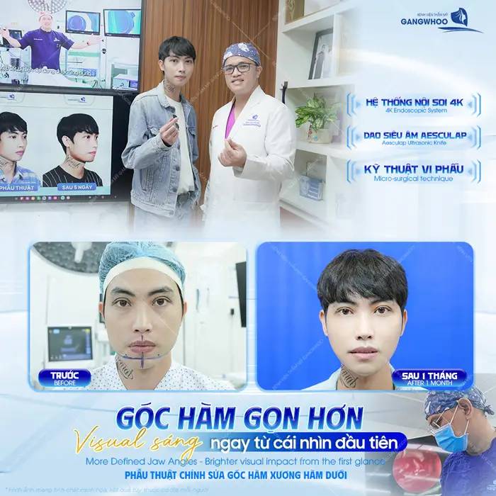 Gọt Hàm Bao Lâu Thì Tháo Nẹp? Hướng Dẫn Chăm Sóc Sau Tháo Nẹp 2 goc ham got ham visual sang hon sau 1 lan can thiep