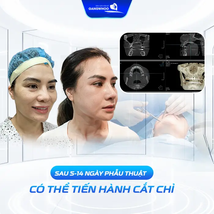 Gọt Hàm Bao Lâu Cắt Chỉ? Hướng Dẫn Chăm Sóc Sau Cắt Chỉ
