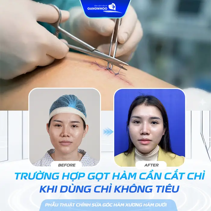 Gọt Hàm Bao Lâu Cắt Chỉ? Hướng Dẫn Chăm Sóc Sau Cắt Chỉ