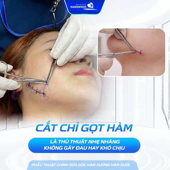 Gọt Hàm Bao Lâu Cắt Chỉ? Hướng Dẫn Chăm Sóc Sau Cắt Chỉ