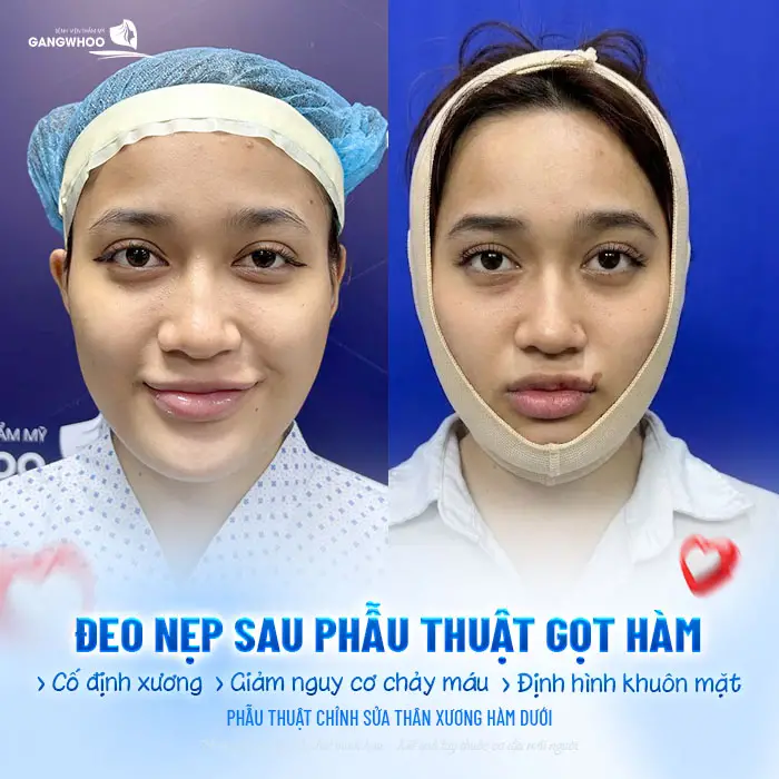 Gọt Hàm Bao Lâu Thì Tháo Nẹp? Hướng Dẫn Chăm Sóc Sau Tháo Nẹp