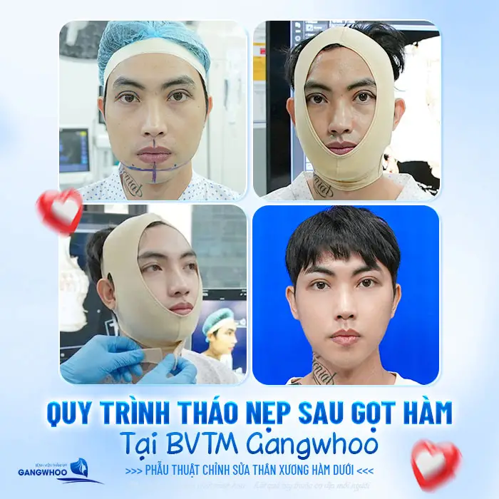 Gọt Hàm Bao Lâu Thì Tháo Nẹp? Hướng Dẫn Chăm Sóc Sau Tháo Nẹp