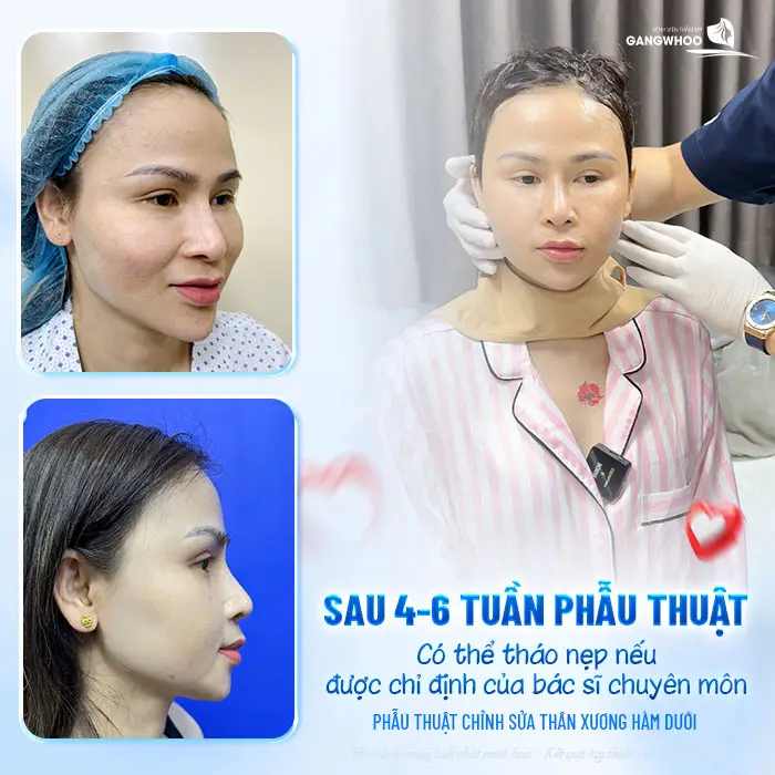 Gọt Hàm Bao Lâu Thì Tháo Nẹp? Hướng Dẫn Chăm Sóc Sau Tháo Nẹp