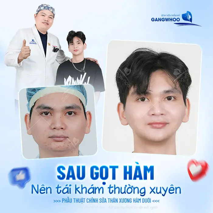 Gọt Hàm Bao Lâu Thì Tháo Nẹp? Hướng Dẫn Chăm Sóc Sau Tháo Nẹp