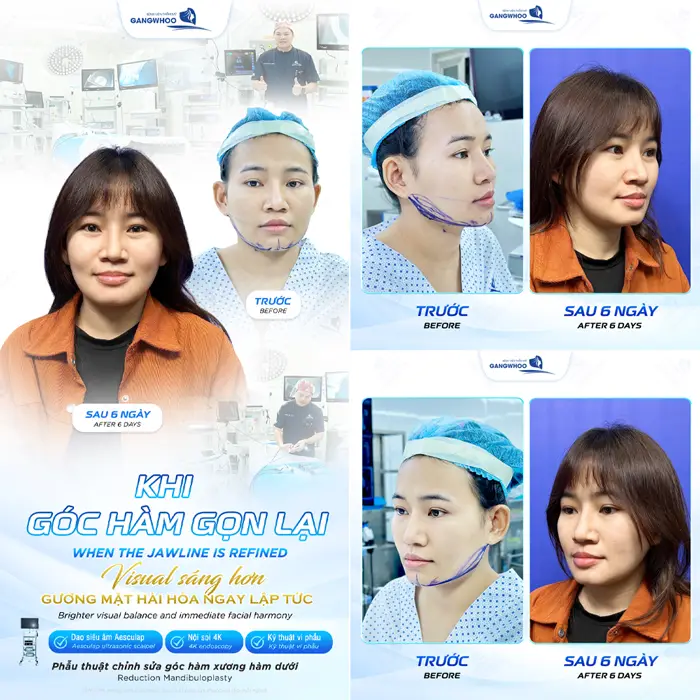 got ham deo dai dinh hinh bao lau 1