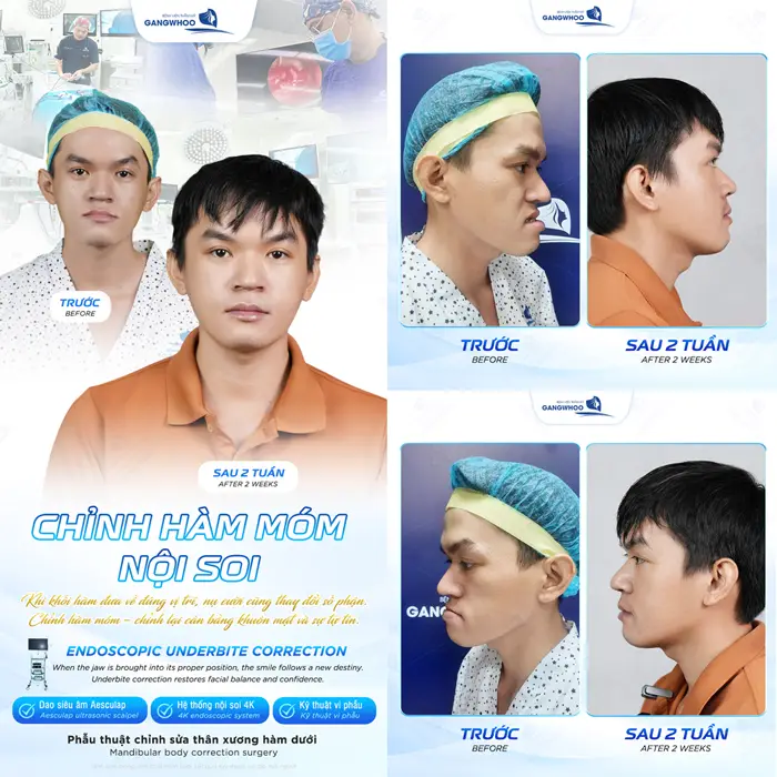 got ham deo dai dinh hinh bao lau 2