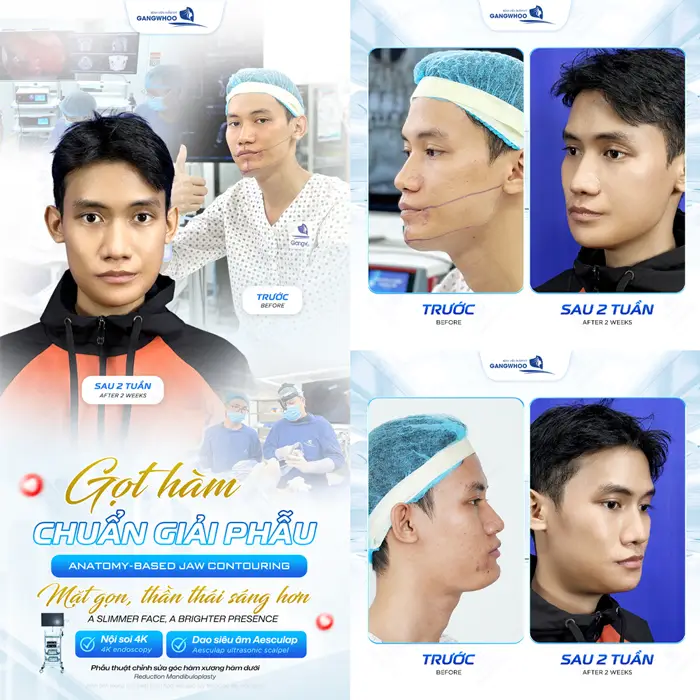 got ham deo dai dinh hinh bao lau 3