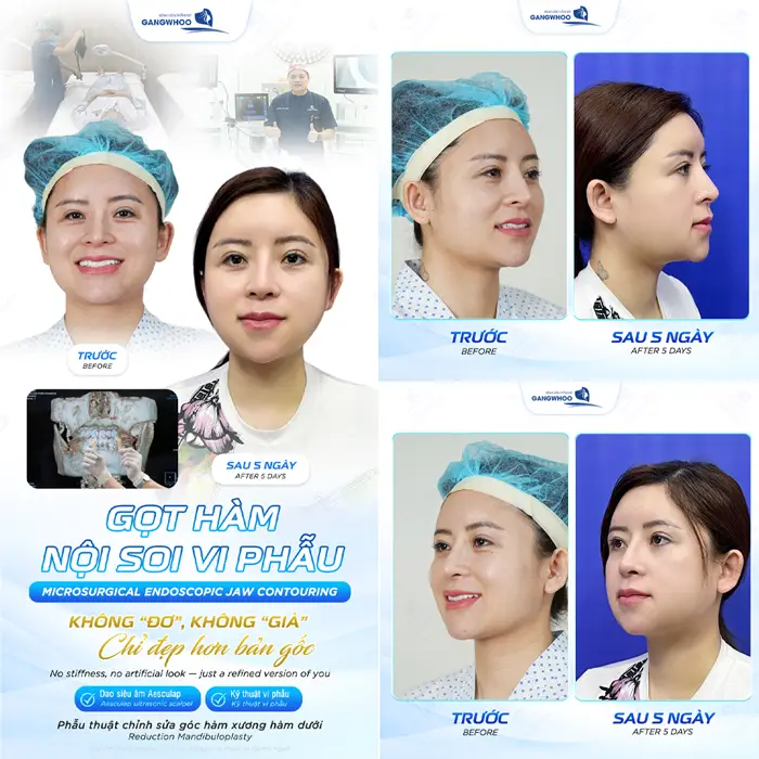 got ham deo dai dinh hinh bao lau 4