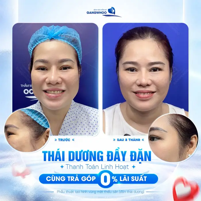 Thái dương đầy đặn đường nét thanh thoát gương mặt thêm đầy đặn và hài hòa sau phẫu thuật 
