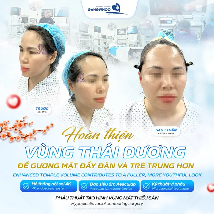 Hoàn thiện vùng thái dương để gương mặt đầy đặn và trẻ trung hơn chỉ sau 1 lần can thiệp 