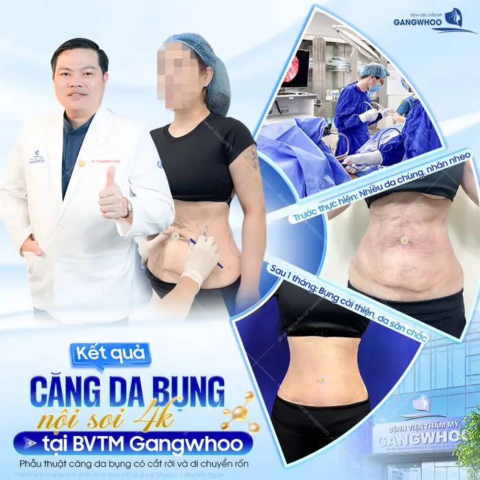 Kết quả căng da bụng nội soi 4K tại BVTM Gangwhoo sau 1 tháng bụng cải thiện da săn chắc đẹp thon gọn nuột nà