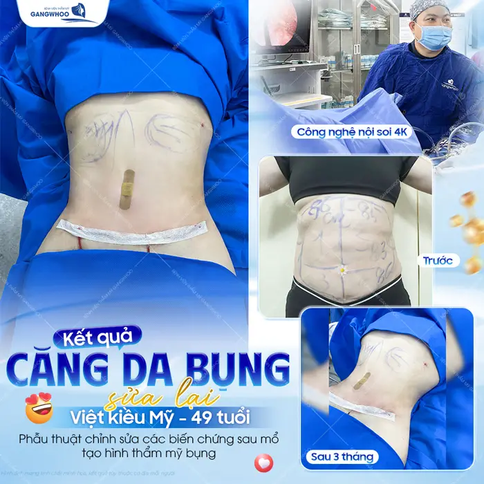 Kết quả căng da bụng sửa lại cho khách Việt Kiều Mỹ đẹp rõ rệt an toàn ngay sau thực hiện