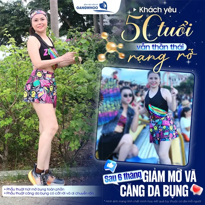 50 tuổi vẫn rạng rỡ và đầy thần thái sau 6 tháng giảm mỡ và căng da bụng 