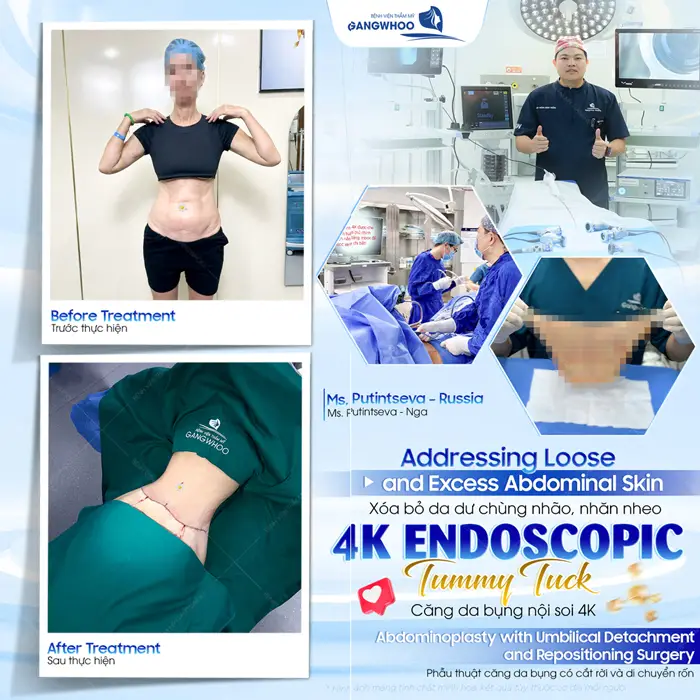 Xóa bỏ da dư chùng nhão, nhăn nheo sau căng da bụng nội soi 4K hiện đại 