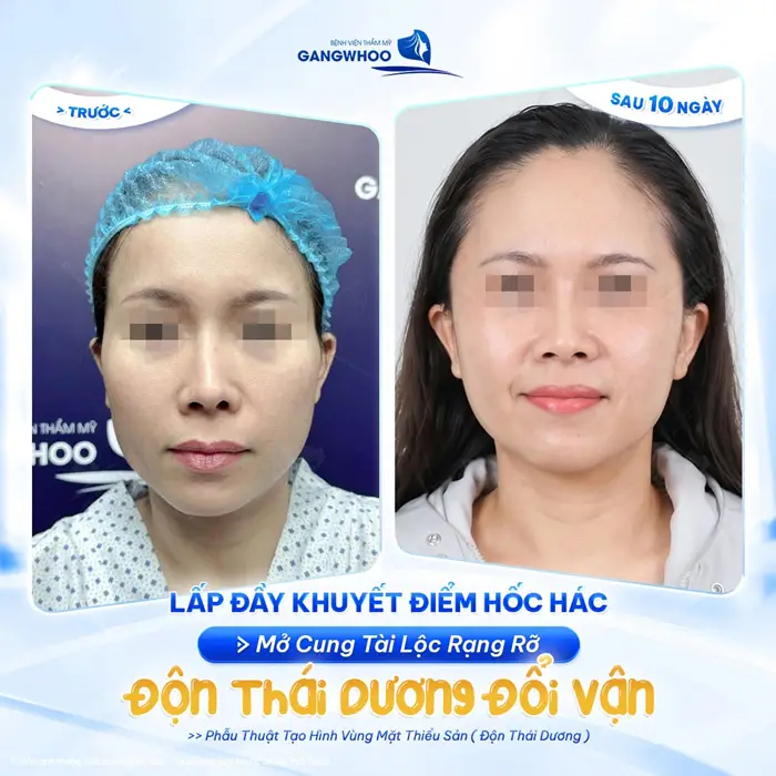 Lấp dầy khuyết điểm hốc hác mở rộng cung tài lộc rạng rỡ sau thực hiện độn thái dương 