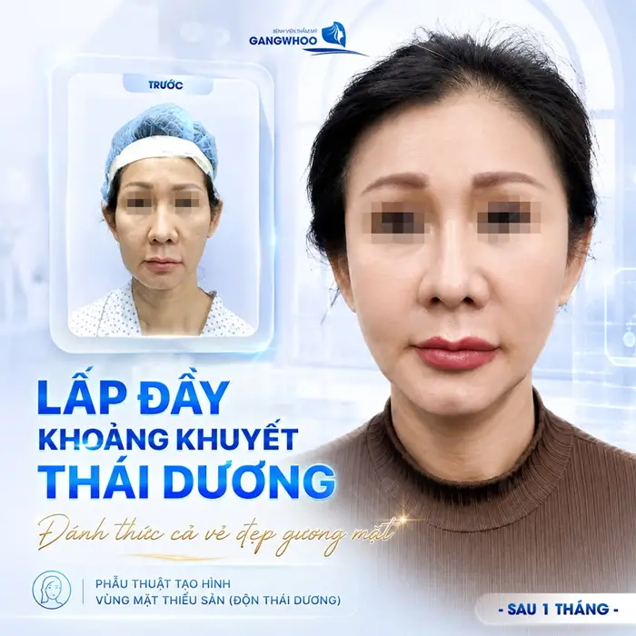 Lấp đầy khoảng khuyết thái dương đánh thức vẻ đẹp của gương mặt