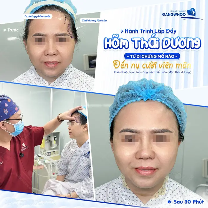 Lấp đầy hõm thái dương từ di chứng mổ não chị khách tìm lại nụ cười tự tin sau độn thái dương