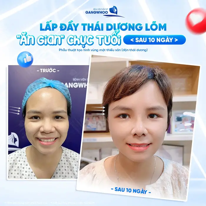 Độn Thái Dương Có Bị Lộ Không? Nguyên Nhân Và Cách Xử Lý 1 Lấp đầy thái dương lõm gương mặt trả ra cả chục tuổi sau thực hiện