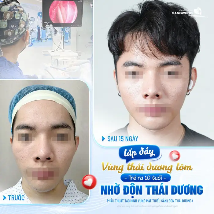 Sau 15 ngày độn thái dương lắp đầy vùng thái dương lõm gương mặt trẻ ra 10 tuổi