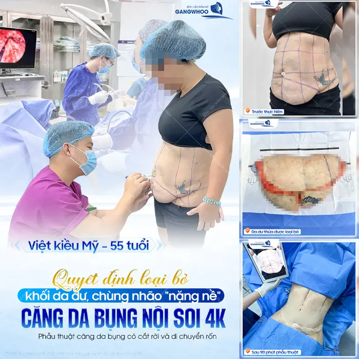 Khách hàng Việt Kiều Mỹ loại bỏ da dư chùng nhão sau phẫu thuật căng da bụng nội soi 4K