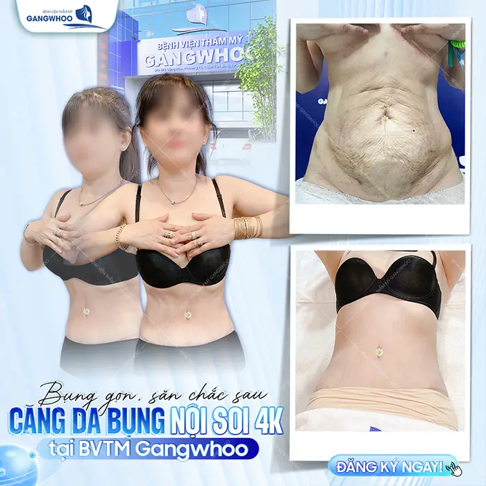 Phẫu Thuật Căng Da Bụng Sau Sinh: Quy Trình Và Chi Phí 2 Phẫu Thuật Căng Da Bụng Sau Sinh: Quy Trình Và Chi Phí