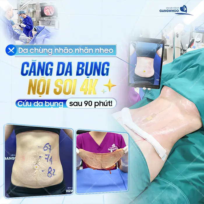 Phẫu Thuật Căng Da Bụng Sau Sinh: Quy Trình Và Chi Phí 3 Phẫu Thuật Căng Da Bụng Sau Sinh: Quy Trình Và Chi Phí