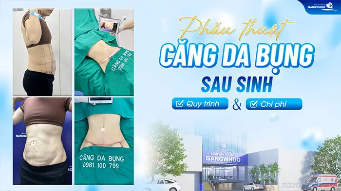 phau thuat cang da bung sau sinh