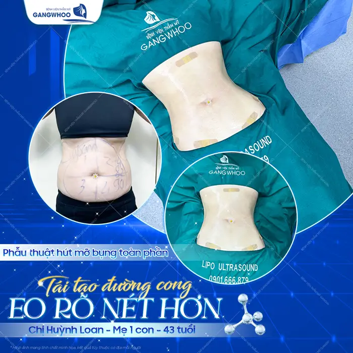 Tái tạo đường cong eo thon rõ nét hơn sự hài lòng của mẹ 1 con 43 tuổi