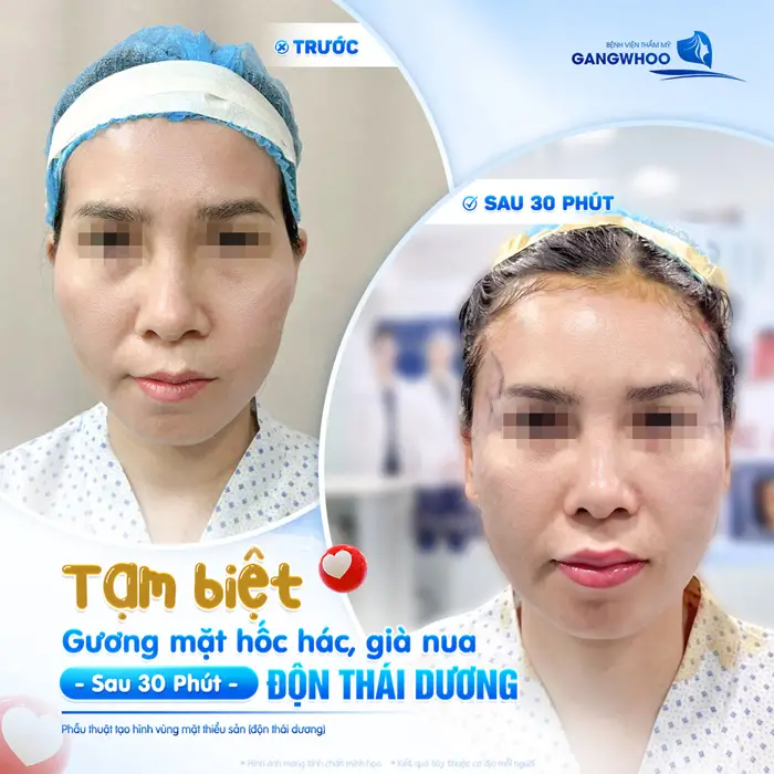 Tạm biệt gương mặt hốc hác, già nua sau 30 phút độn thái dương gương mặt hài hòa, đường nét thêm căng tròn và phút hậu