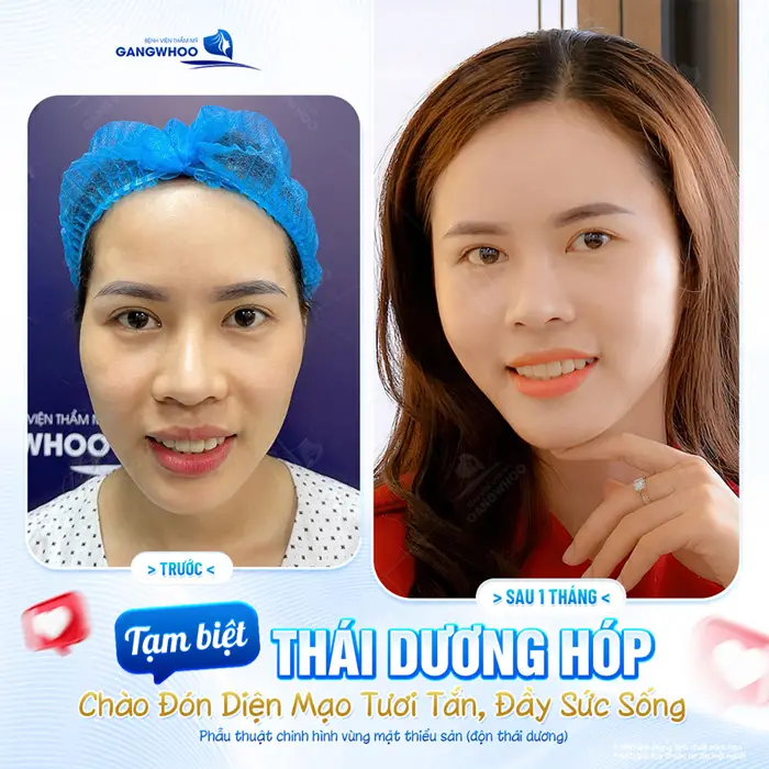 Tạm biệt thái dương hóp chào đón diện mạo mới tươi tắn và tràn đầy sức sống 