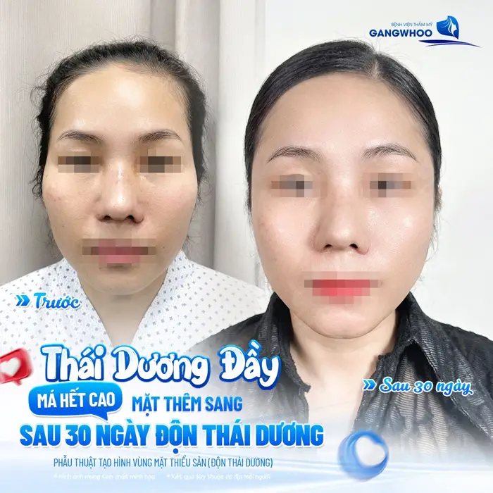 Lấp đầy thái dương má hết cao mặt thêm sang sau 30 ngày kết quả đã hồi phục và tự nhiên hơn thấy rõ