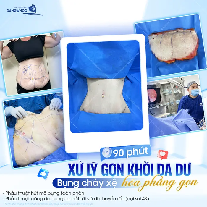 Bác Sĩ Hướng Dẫn Chăm Sóc Sau Khi Căng Da Bụng Chuẩn Y Khoa 1 90 phút xử lý gọn khối da dư bụng chảy xệ hóa phẳng gọn an toàn, nhẹ nhàng và hiệu quả nhanh chóng