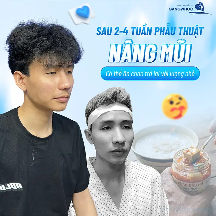 Nâng Mũi Ăn Chao Được Không? Kiêng Trong Bao Lâu?