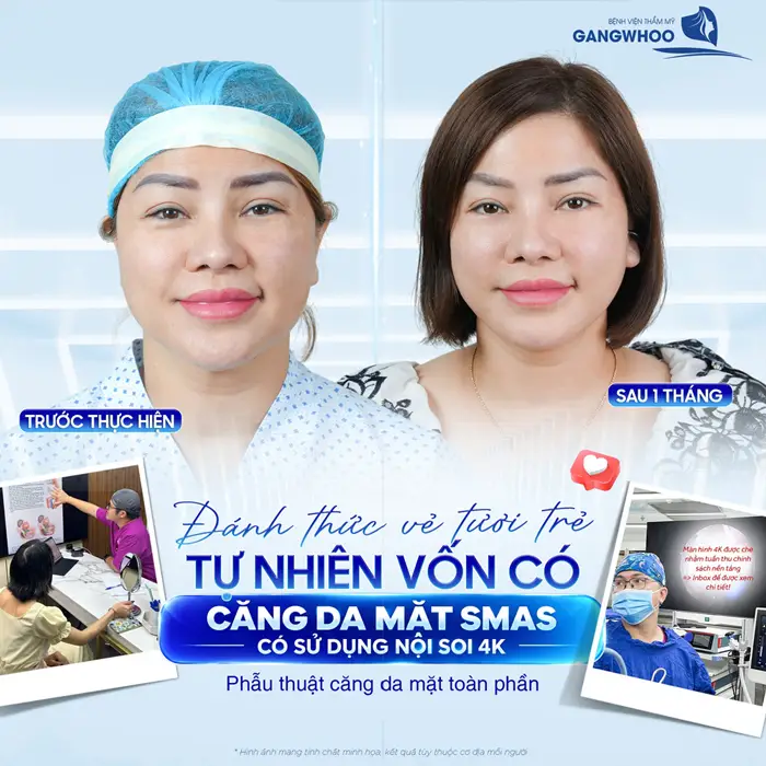 Căng Da Mặt Nội Soi 4K Không Để Lại Sẹo Nhờ Kỹ Thuật Vi Phẫu 1 Đánh thức vẻ đẹp tươi trẻ tự nhiên vốn có của gương mặt sau căng da mặt Smas có sử dụng nội soi 4K