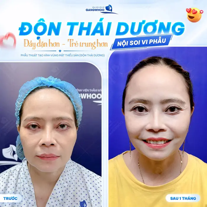 Độn thái dương đầy đặn hơn, trẻ trung hơn với công nghệ nội soi 4K hiện đại diện mạo thêm trẻ đẹp và đầy rạng rỡ