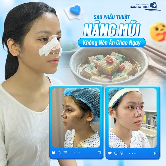 Nâng Mũi Ăn Chao Được Không? Kiêng Trong Bao Lâu?