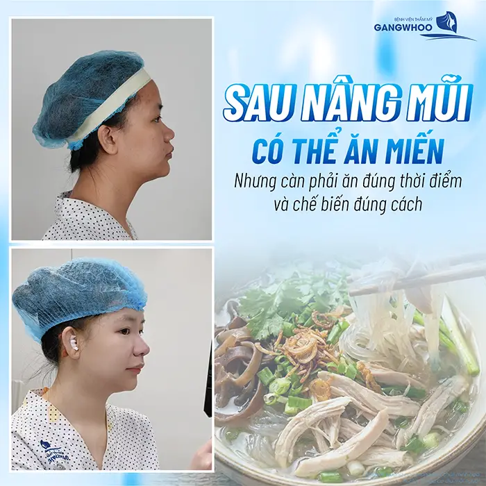 Nâng Mũi Ăn Miến Được Không? Bao Lâu Thì Ăn Được?