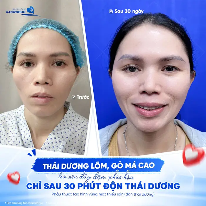 Nên Độn Thái Dương Hay Tiêm Filler Hay Cấy Mỡ - Bác Sĩ Giải Đáp 5 Thái dương lõm, gò má cao trở nên đầy đặn và phúc hậu hơn sau 30 phút độn thái dương tại BVTM Gangwhoo