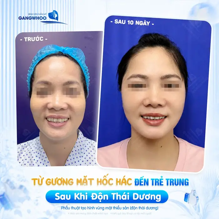Từ gương mặt hốc hác đến gương mặt trẻ trung sau 10 ngày độn thái dương 