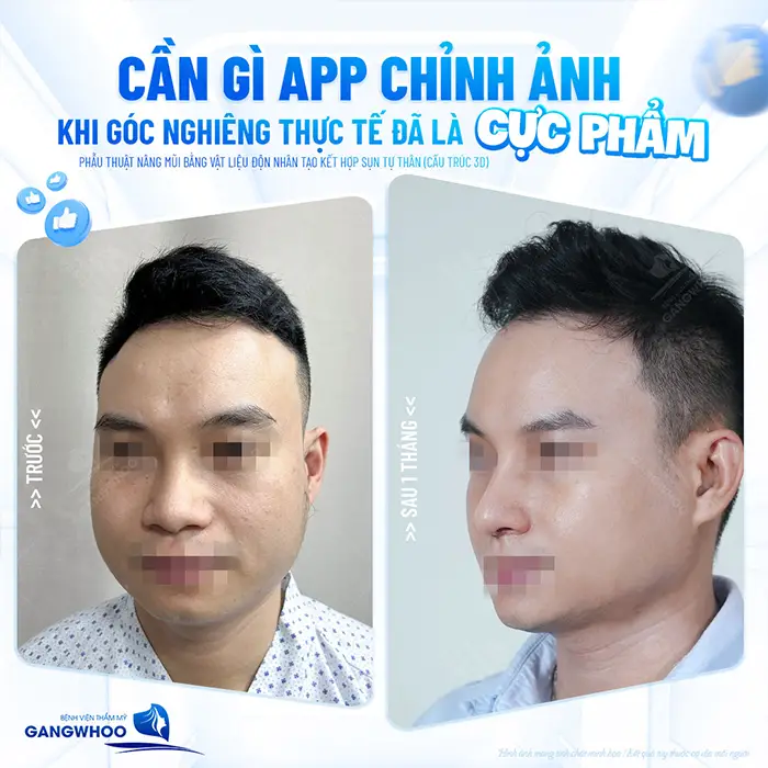 Review 10 Địa Chỉ Nâng Mũi Nam Đẹp Tại TPHCM
