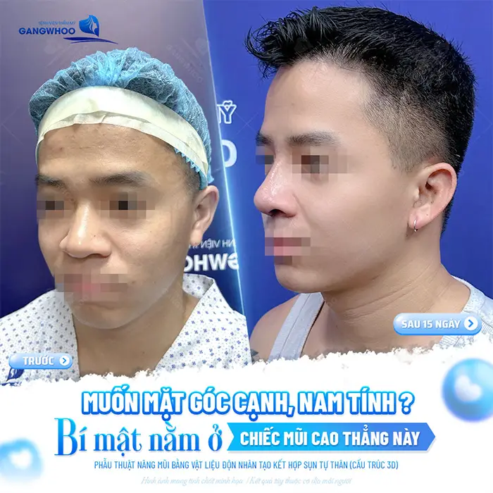 Review 10 Địa Chỉ Nâng Mũi Nam Đẹp Tại TPHCM