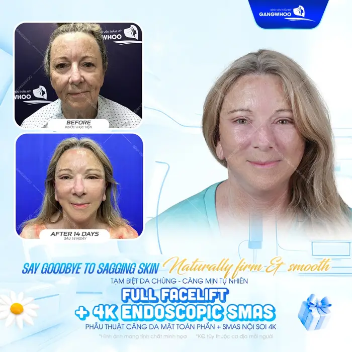 Hành Trình Níu Giữ Tuổi Xuân Của Đôi Bạn Thân 40 Năm Tại BVTM Gangwhoo 2 Tạm biệt da chùng lấy lại làn da căng mịn tự nhiên sau phẫu thuật căng da mặt toàn phần Smas nội soi 4K